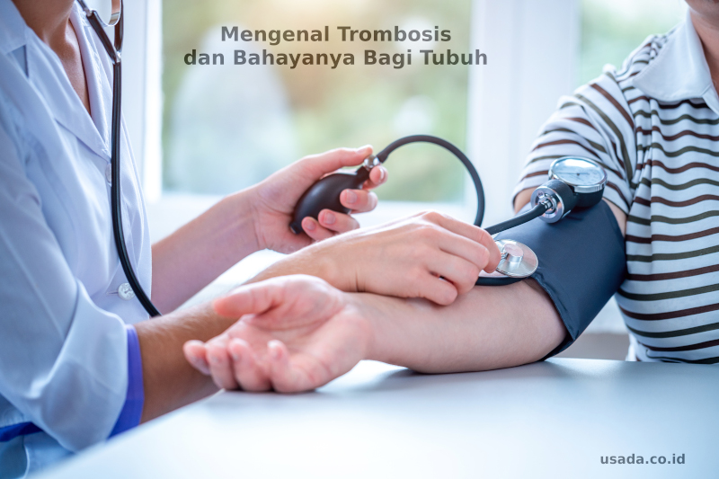 Mengenal Apa Itu Trombosis dan Bahayanya Bagi Tubuh